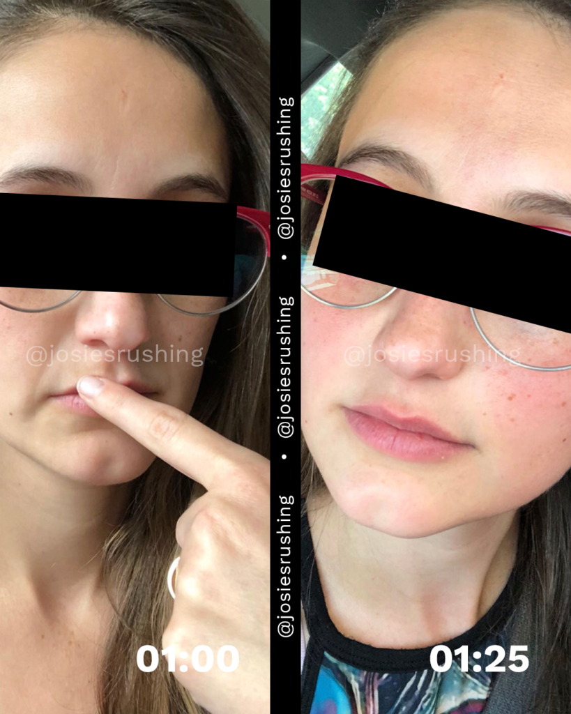 Before and After - Brazilian Lymphatic Drainage