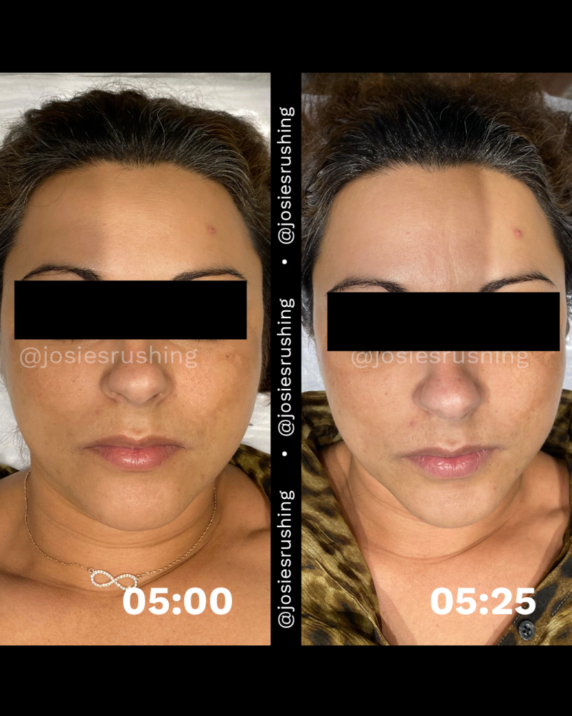 Before and After - Brazilian Lymphatic Drainage