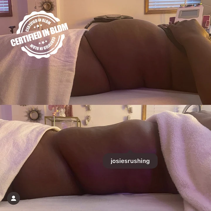 Before and After - Brazilian Lymphatic Drainage