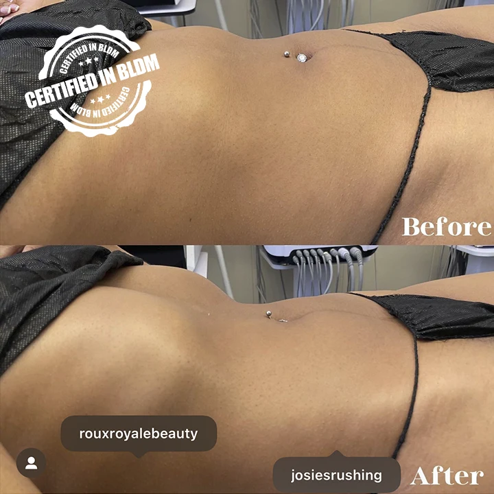 Before and After - Brazilian Lymphatic Drainage