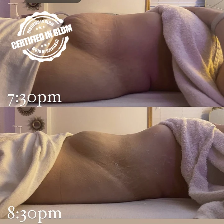 Before and After - Brazilian Lymphatic Drainage