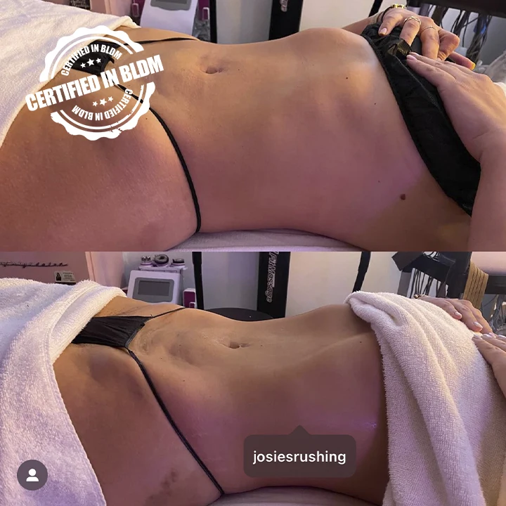 Before and After - Brazilian Lymphatic Drainage