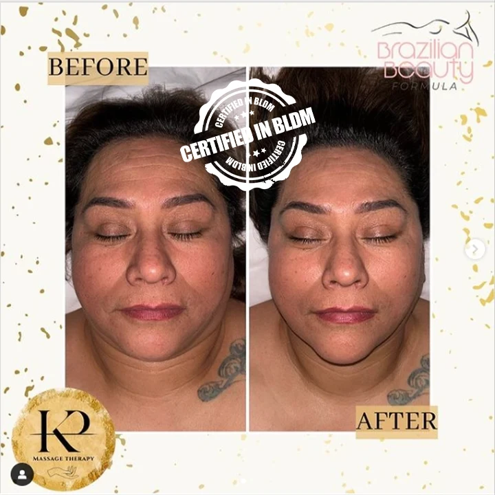 Before and After - Brazilian Lymphatic Drainage