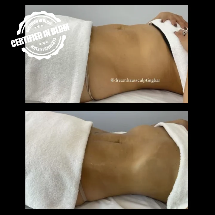 Before and After - Brazilian Lymphatic Drainage