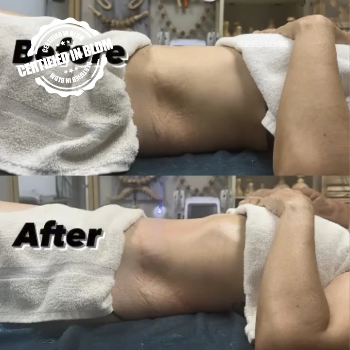 Before and After - Brazilian Lymphatic Drainage