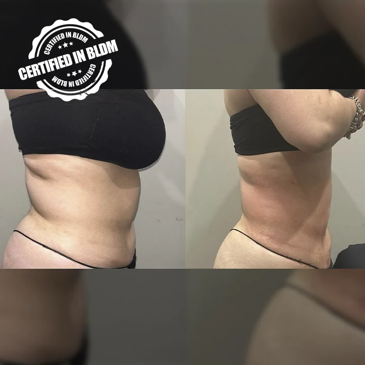 Before and After - Brazilian Lymphatic Drainage