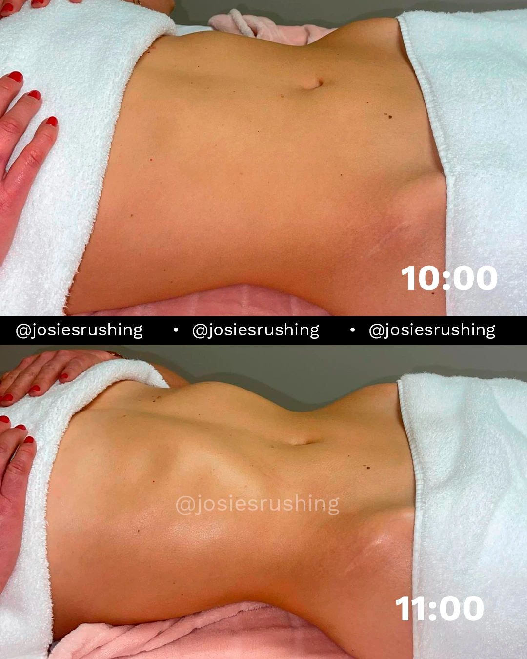 Before and After - Brazilian Lymphatic Drainage
