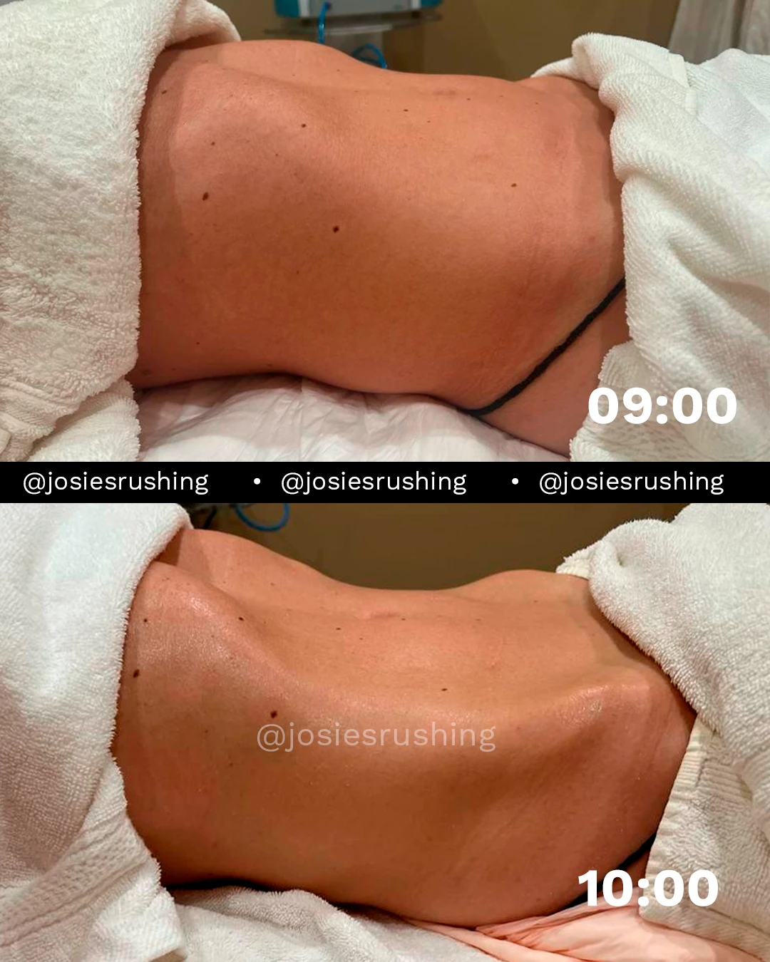 Before and After - Brazilian Lymphatic Drainage