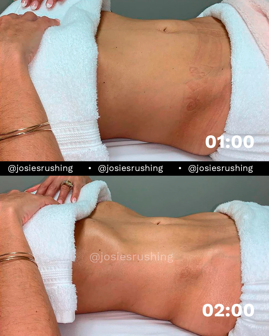 Before and After - Brazilian Lymphatic Drainage
