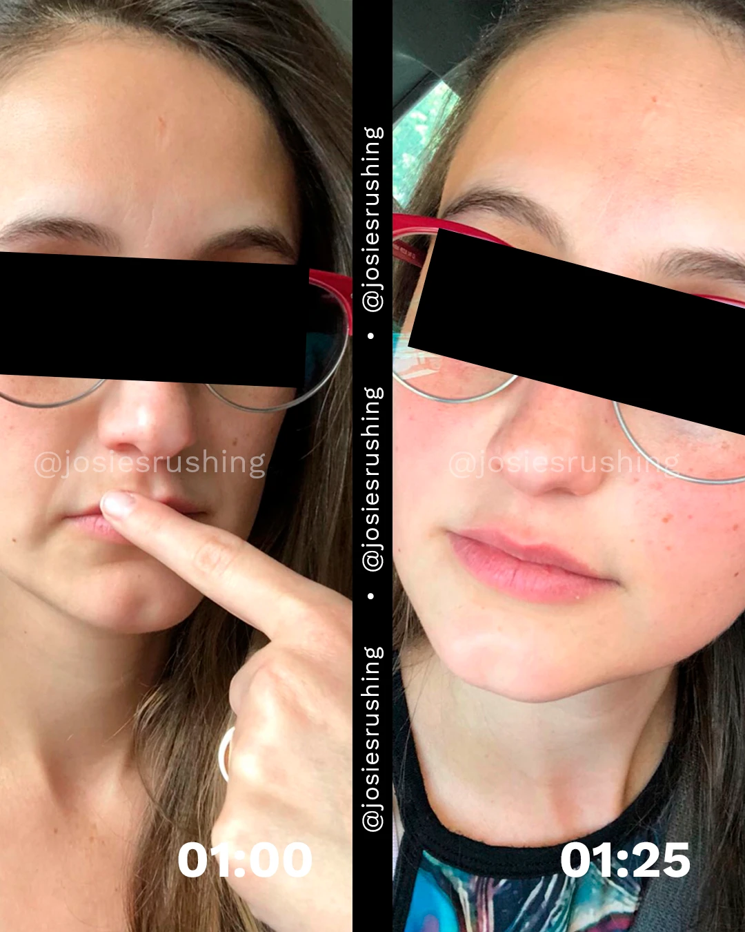 Before and After - Brazilian Lymphatic Drainage