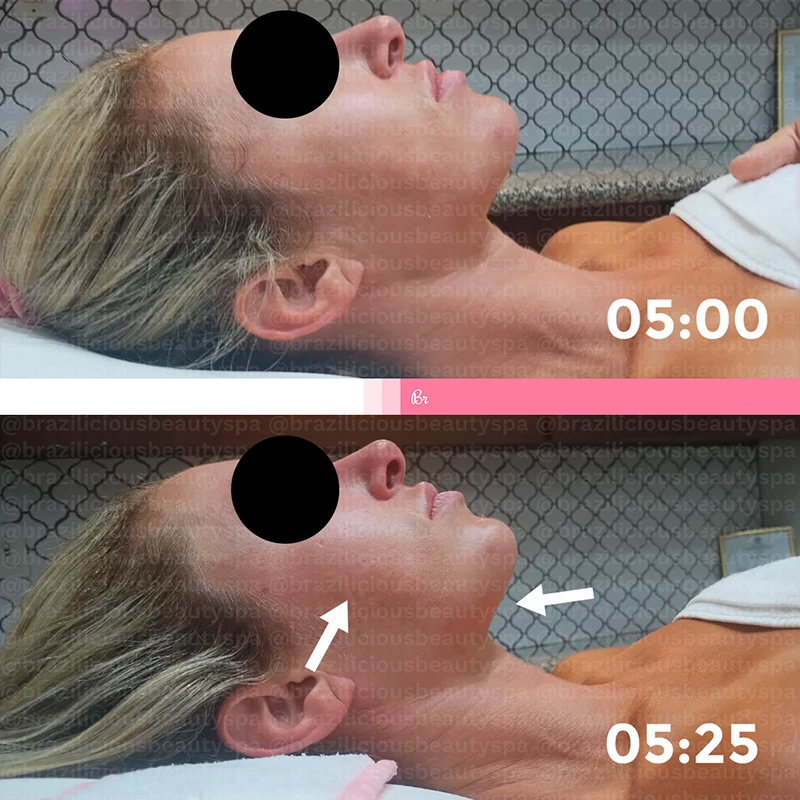 Before and After - Brazilian Lymphatic Drainage
