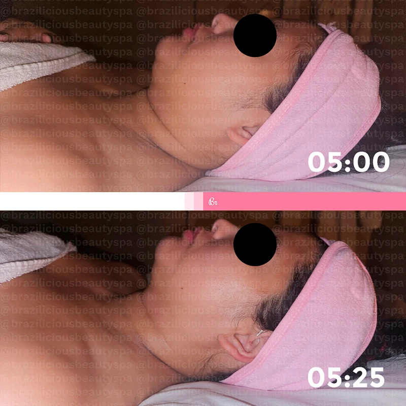 Before and After - Brazilian Lymphatic Drainage