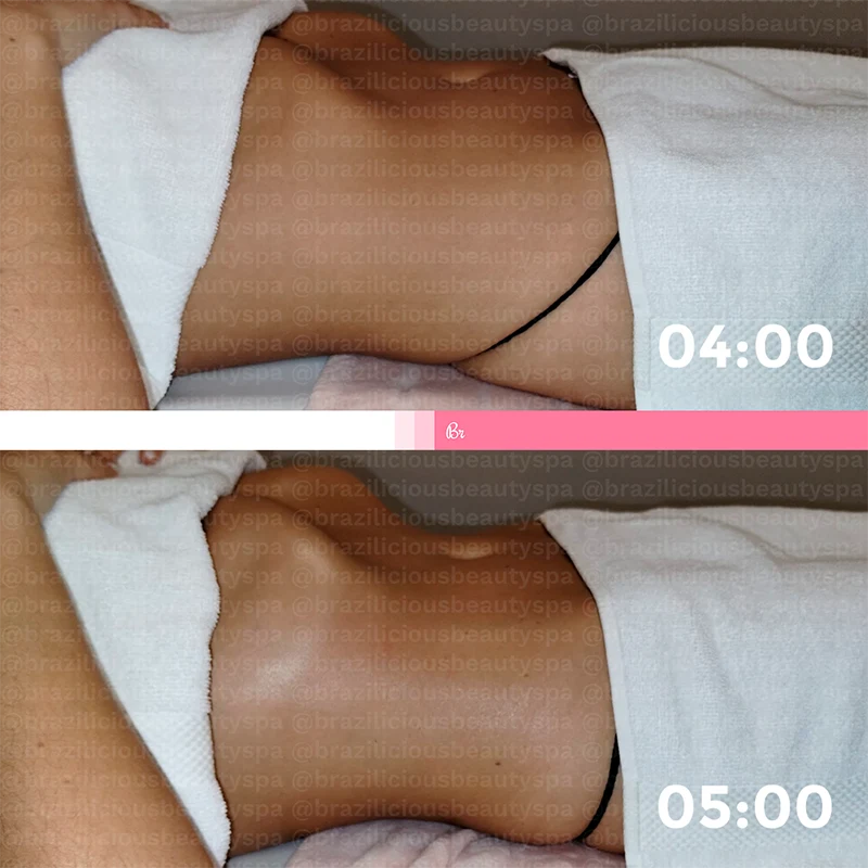 Before and After - Brazilian Lymphatic Drainage