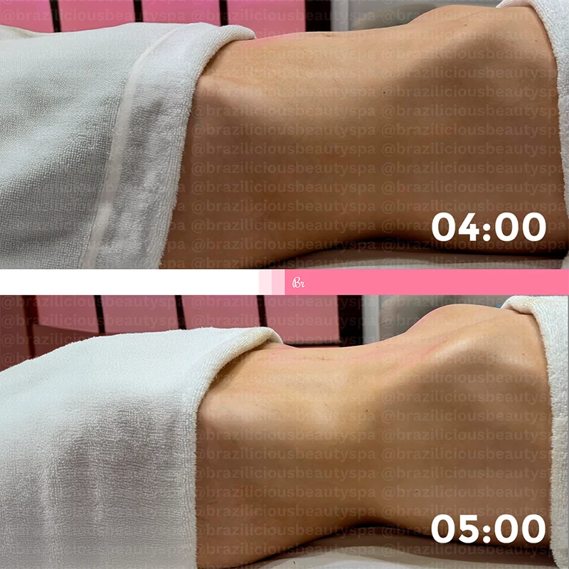 Before and After - Brazilian Lymphatic Drainage