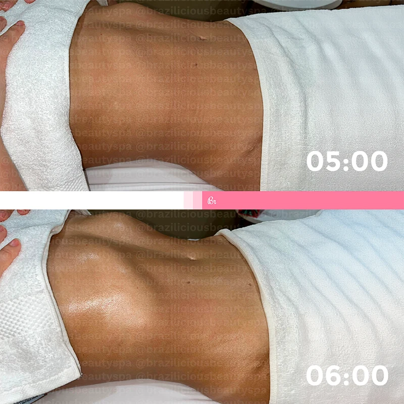 Before and After - Brazilian Lymphatic Drainage
