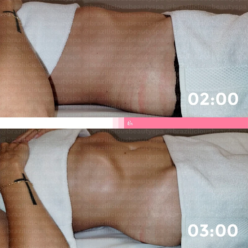 Before and After - Brazilian Lymphatic Drainage