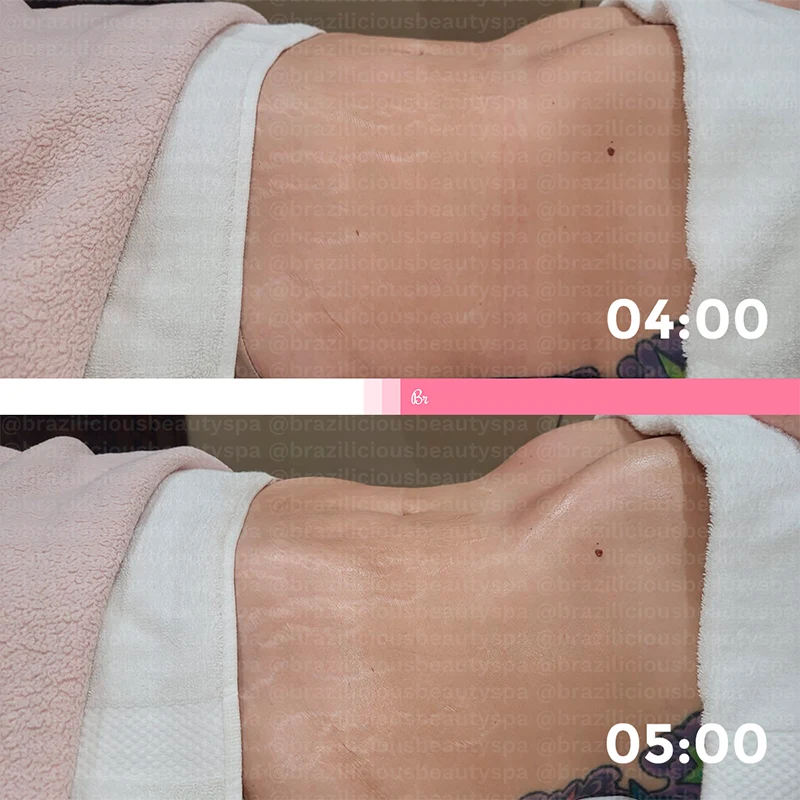 Before and After - Brazilian Lymphatic Drainage