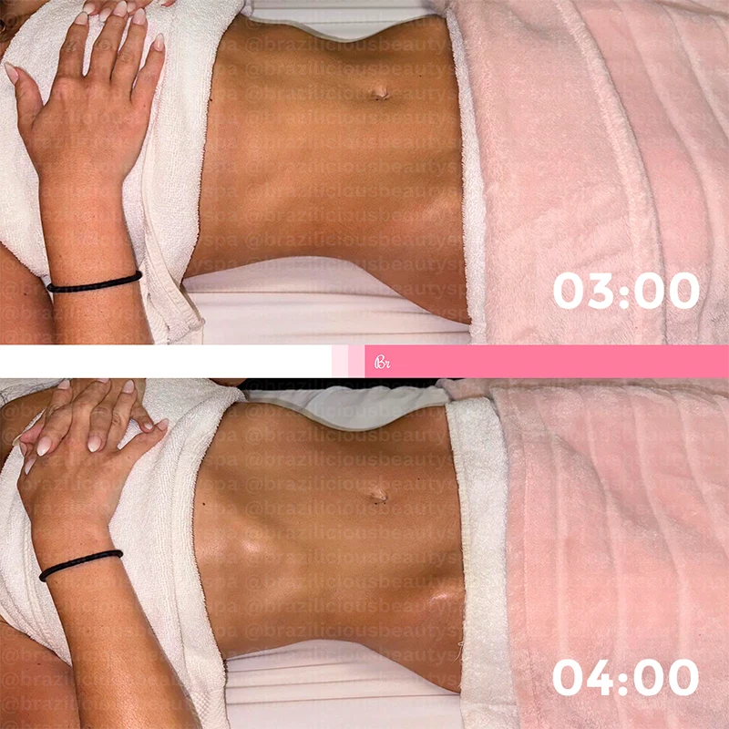 Before and After - Brazilian Lymphatic Drainage
