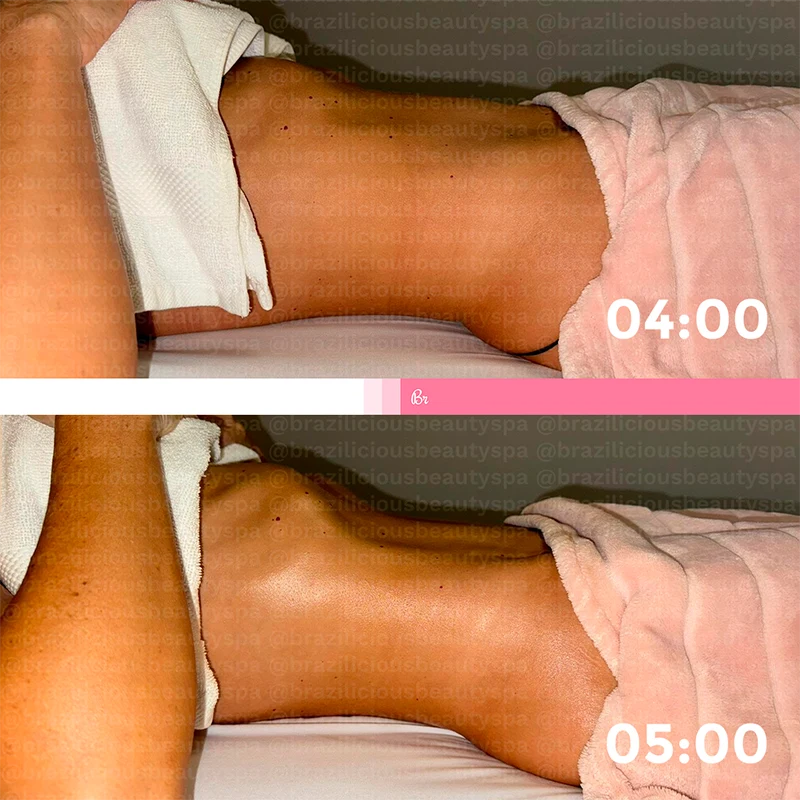 Before and After - Brazilian Lymphatic Drainage