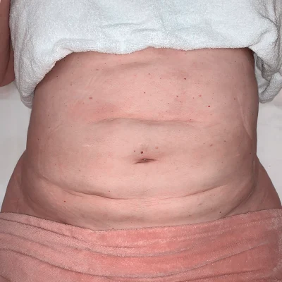 Fibrosis 1