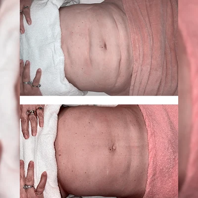Fibrosis 6