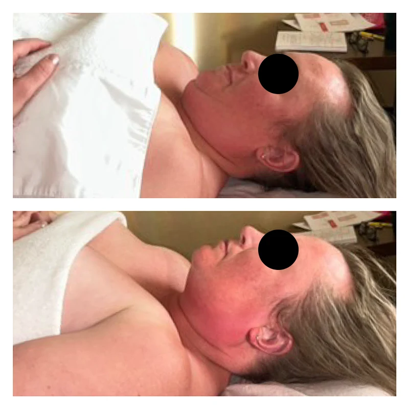 Face-Before-and-After-Denver.webp