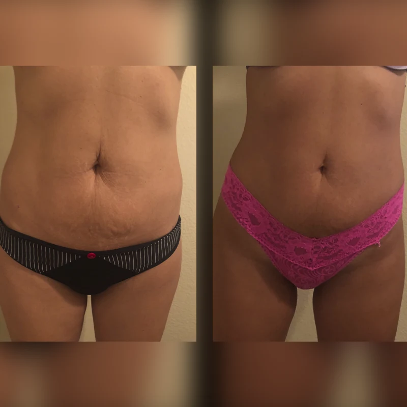Before and after 1