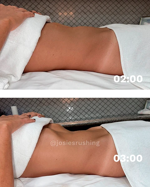 Before and After - Authentic Brazilian Lymphatic