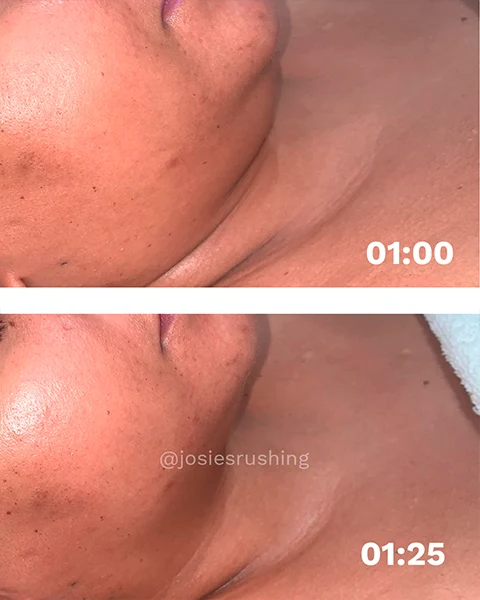 Before and After - Authentic Brazilian Lymphatic