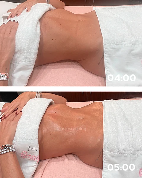 Before and After - Authentic Brazilian Lymphatic