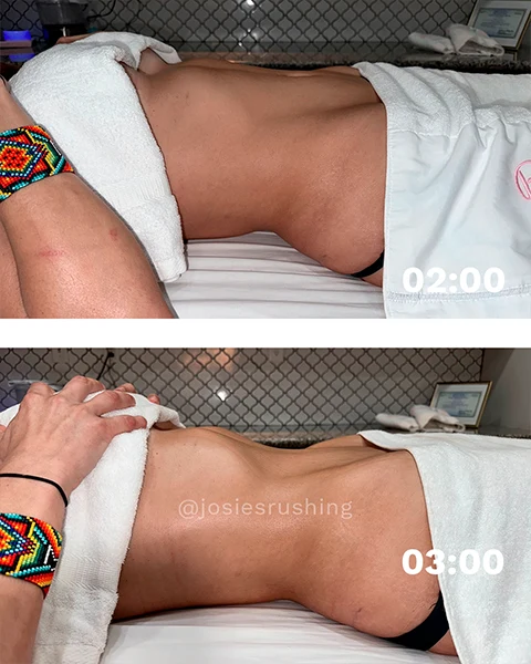 Before and After - Authentic Brazilian Lymphatic