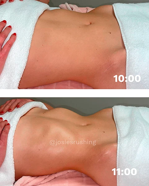 Before and After - Authentic Brazilian Lymphatic