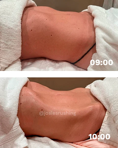 Before and After - Authentic Brazilian Lymphatic