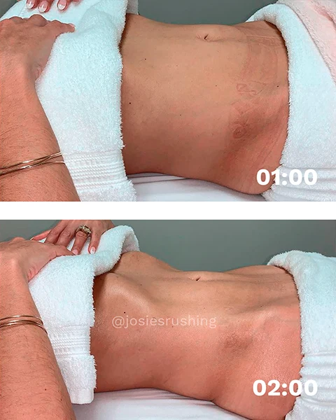 Before and After - Authentic Brazilian Lymphatic