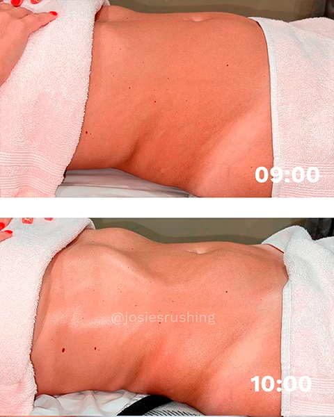 Before and After - Authentic Brazilian Lymphatic