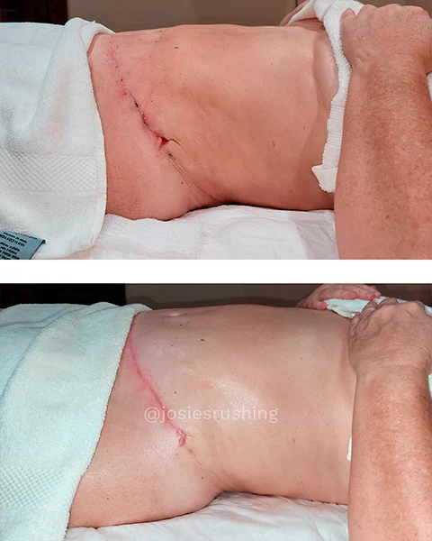 Before and After - Authentic Brazilian Lymphatic