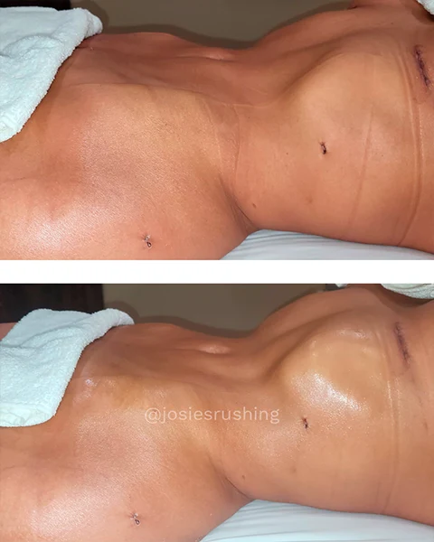 Before and After - Authentic Brazilian Lymphatic