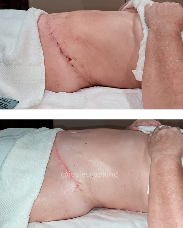Post Surgery 2