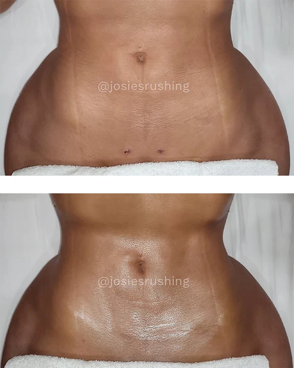 Before and After Post Surgery